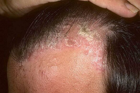 Psoriasis symptoms