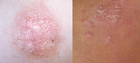 Psoriasis at the initial stadium