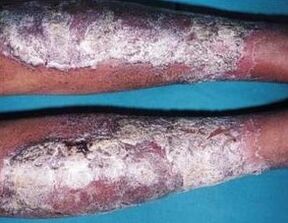 Psoriasis ointment